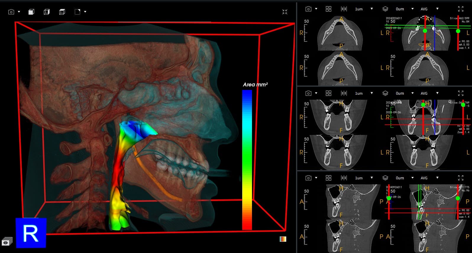 Airway Volume Analysis