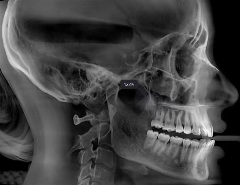 High-Resolution Lateral Ceph