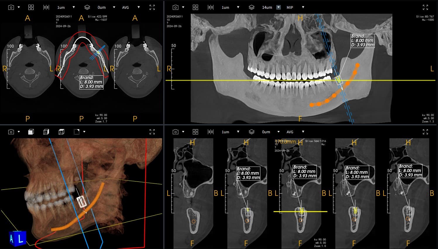 Implant Planning with Cross-Sections