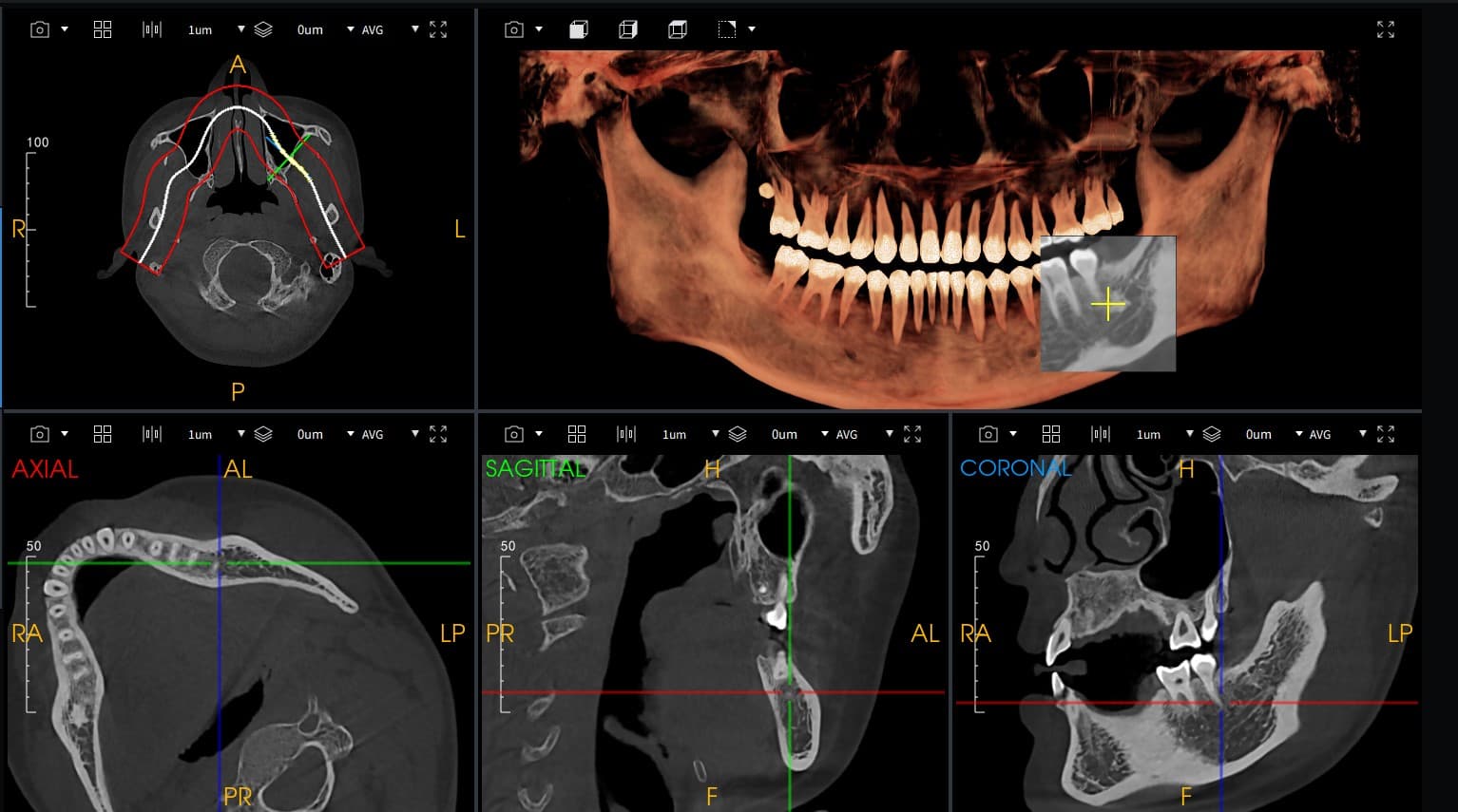 CBCT Quad-View — Axial, 3D, Sagittal, Coronal